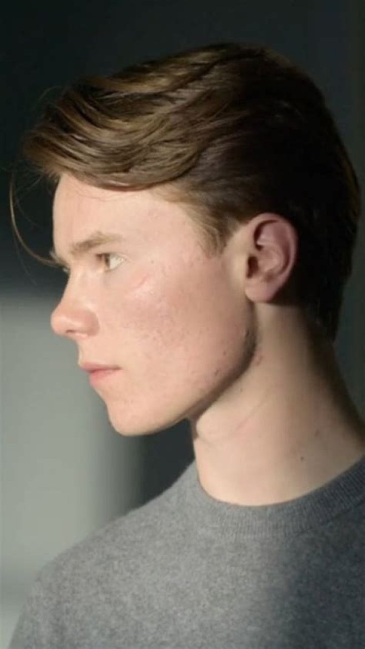 Edvin Ryding Acne: Twitter Post About Physical Appearance Gone Viral