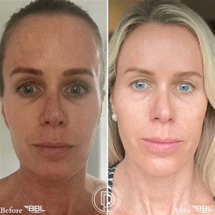 Jodie Woods BBL Surgery: Before And After Photos