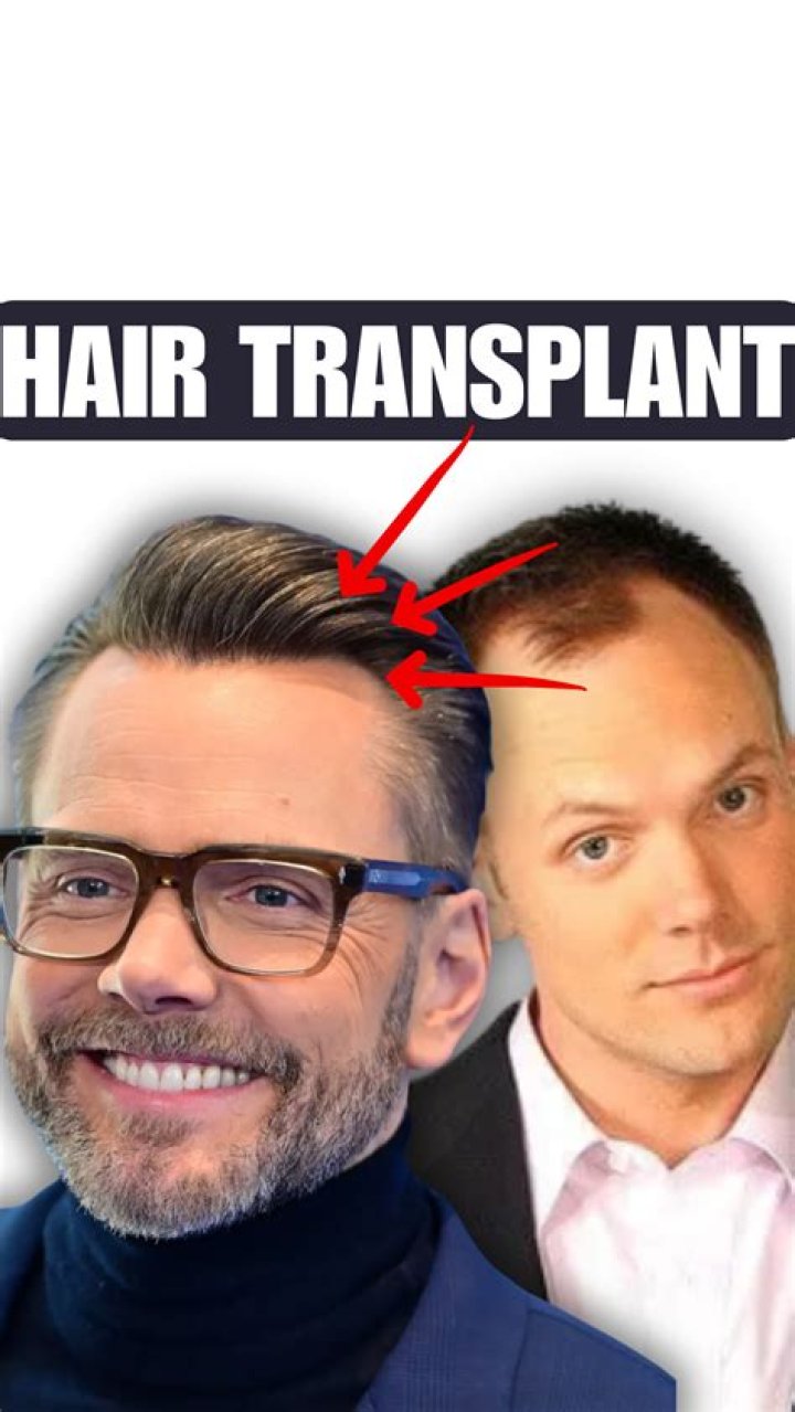 It Took Joel McHale Three Hair Transplants to Save Himself from Going Bald