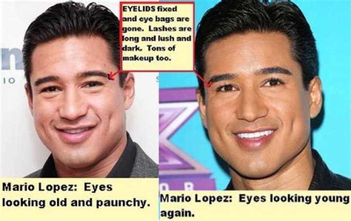 Mario Lopez did undergo surgery, but it had nothing to do with his looks